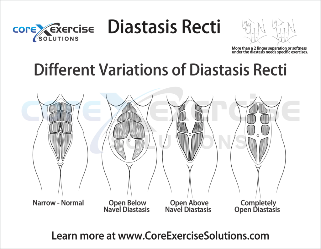 Diastasis Fix: Strengthen Your Abs, Connect Your Core