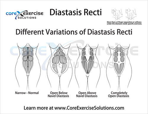 Should You Go for the Diastasis or Hernia Repair - Core Exercise