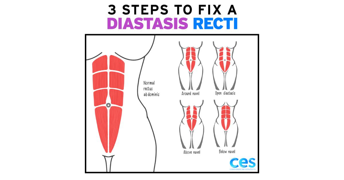 Diastasis Recti Exercises: How to Fix Diastasis Recti