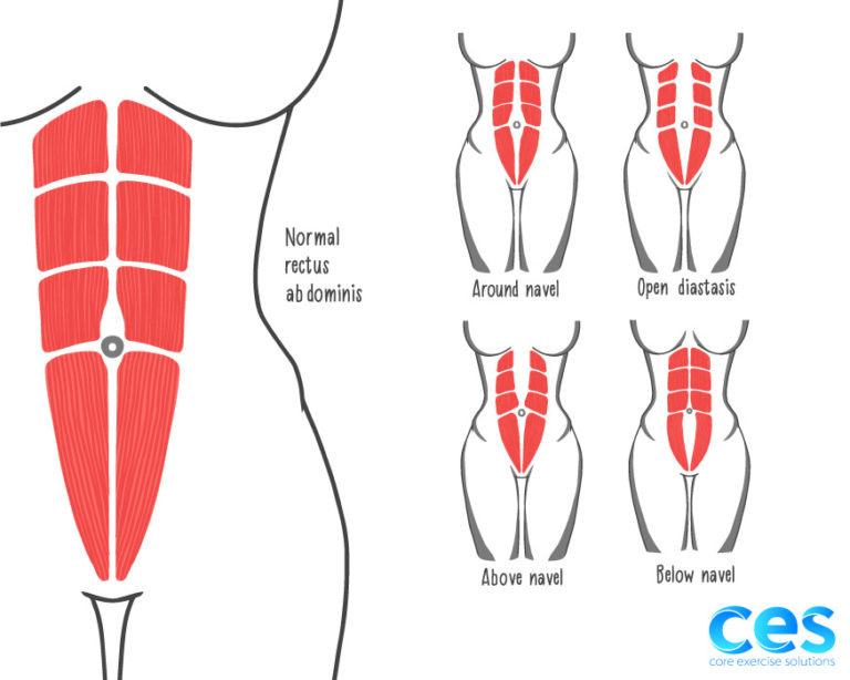 3 Steps to Fix a Diastasis Recti - Core Exercise Solutions