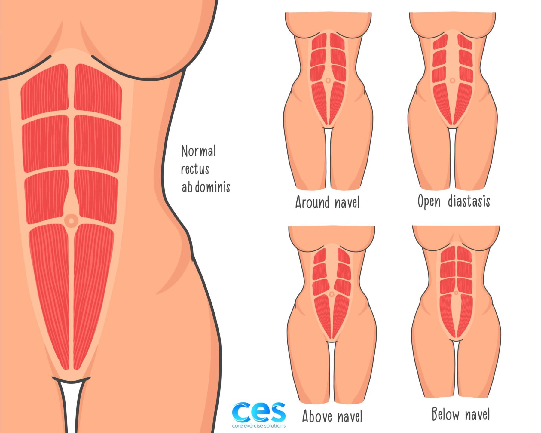 Body FX - Client has Diastasis Recti, also known as abdominal
