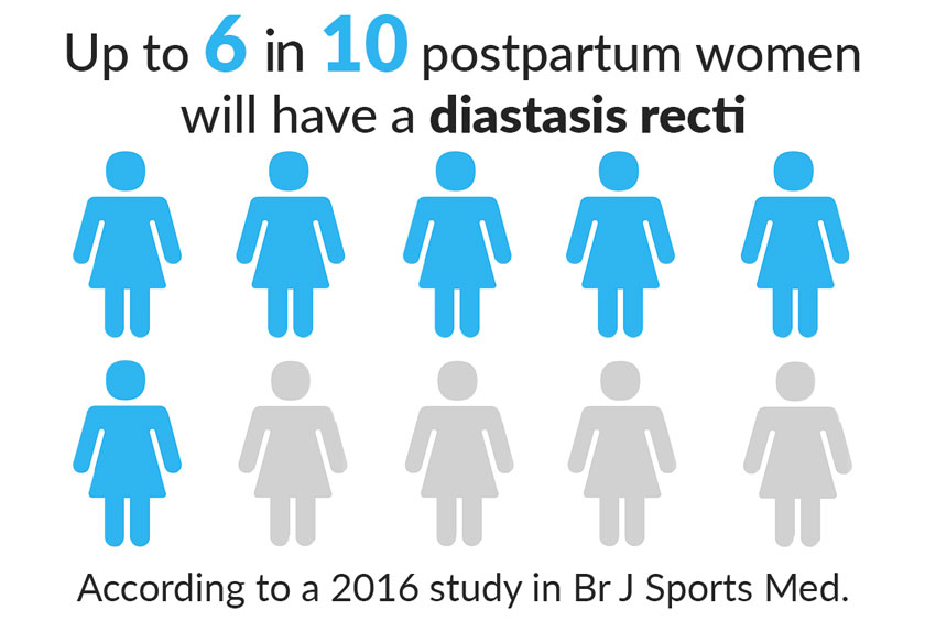 Up to 6 in 10 postpartum women will have a diastasis recti